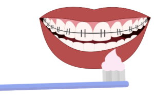 talking about dental braces